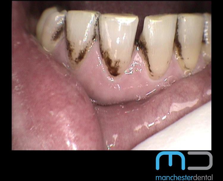 Stain Removal Manchester Dental