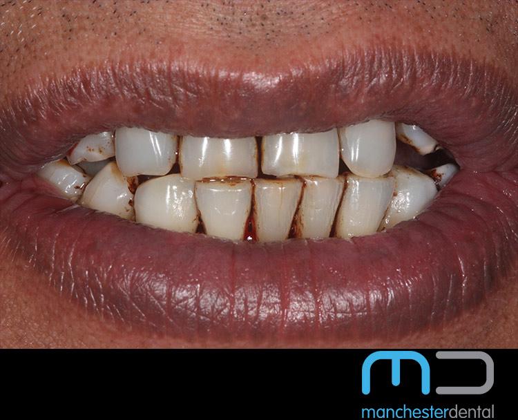 Stain Removal Manchester Dental