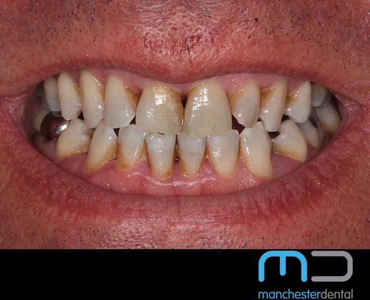 Stain Removal Manchester Dental