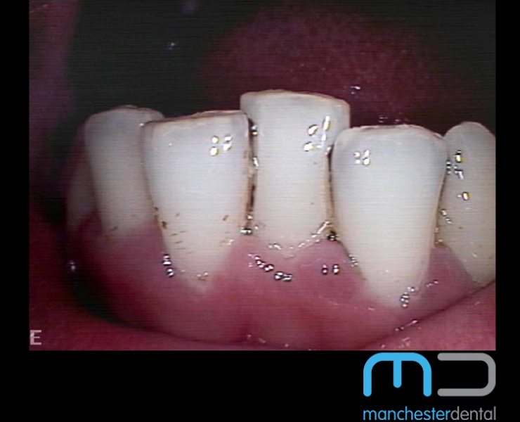 Stain Removal Manchester Dental