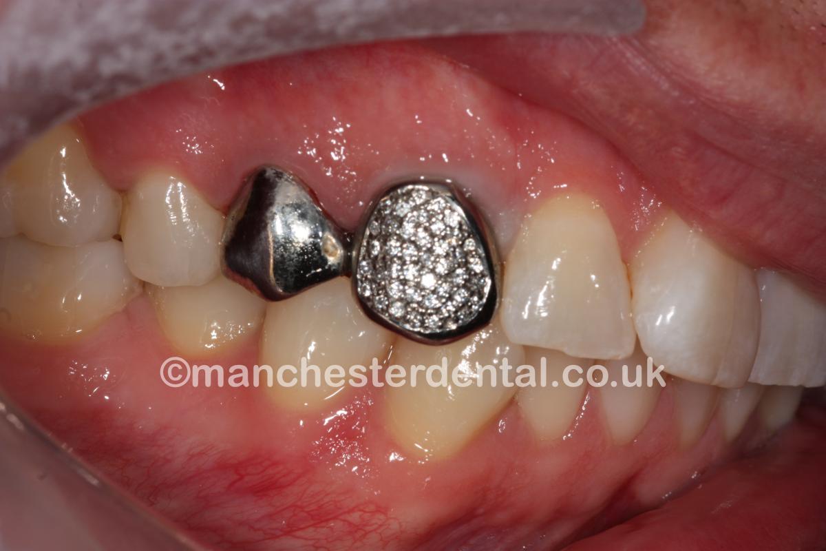 Gold Teeth / Gold Crowns Manchester Dental