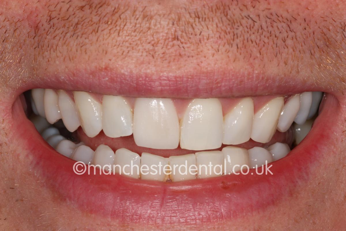 Crowns & Veneers Manchester Dental