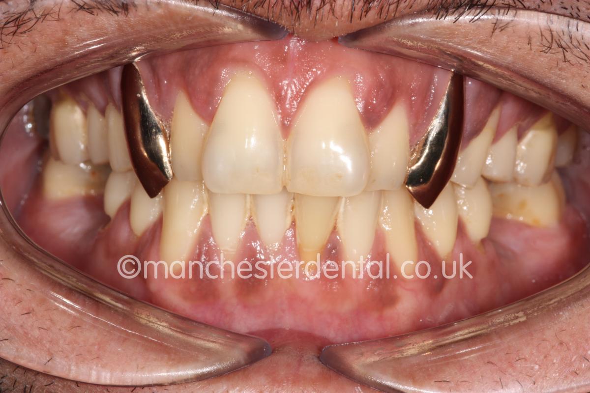 Gold Teeth / Gold Crowns Manchester Dental
