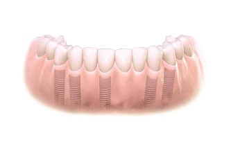 dental implants in manchester