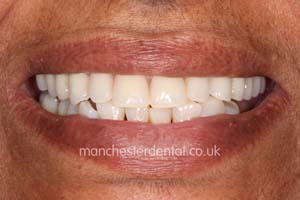 Manchester dental teeth in a day after