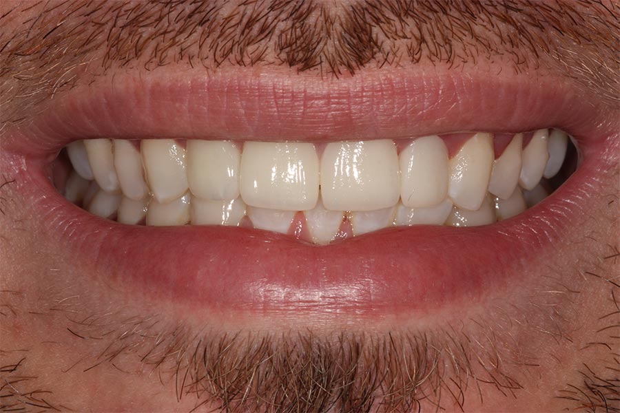 CrownsandVeneers Manchester Dental