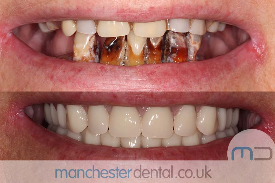 Smile Makeover In Manchester - Manchester Dental