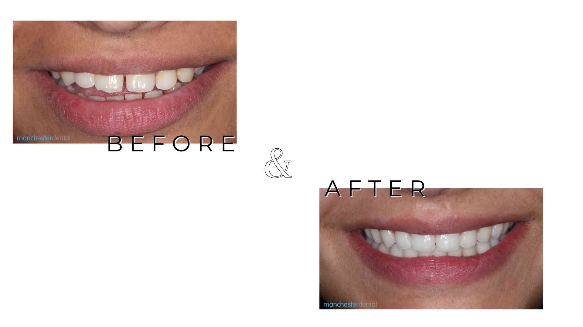 composite bonding in manchester Manchester Dental