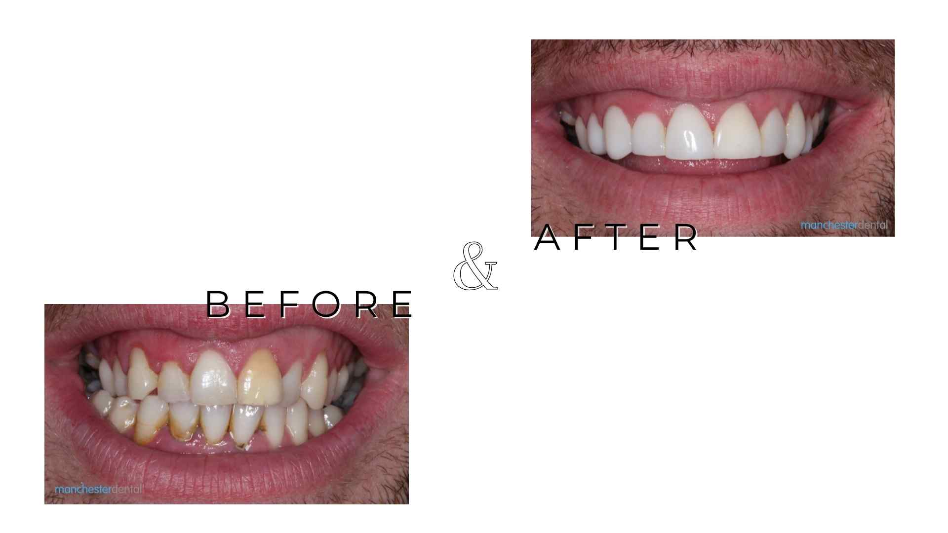 Best composite bonding in Manchester Manchester Dental