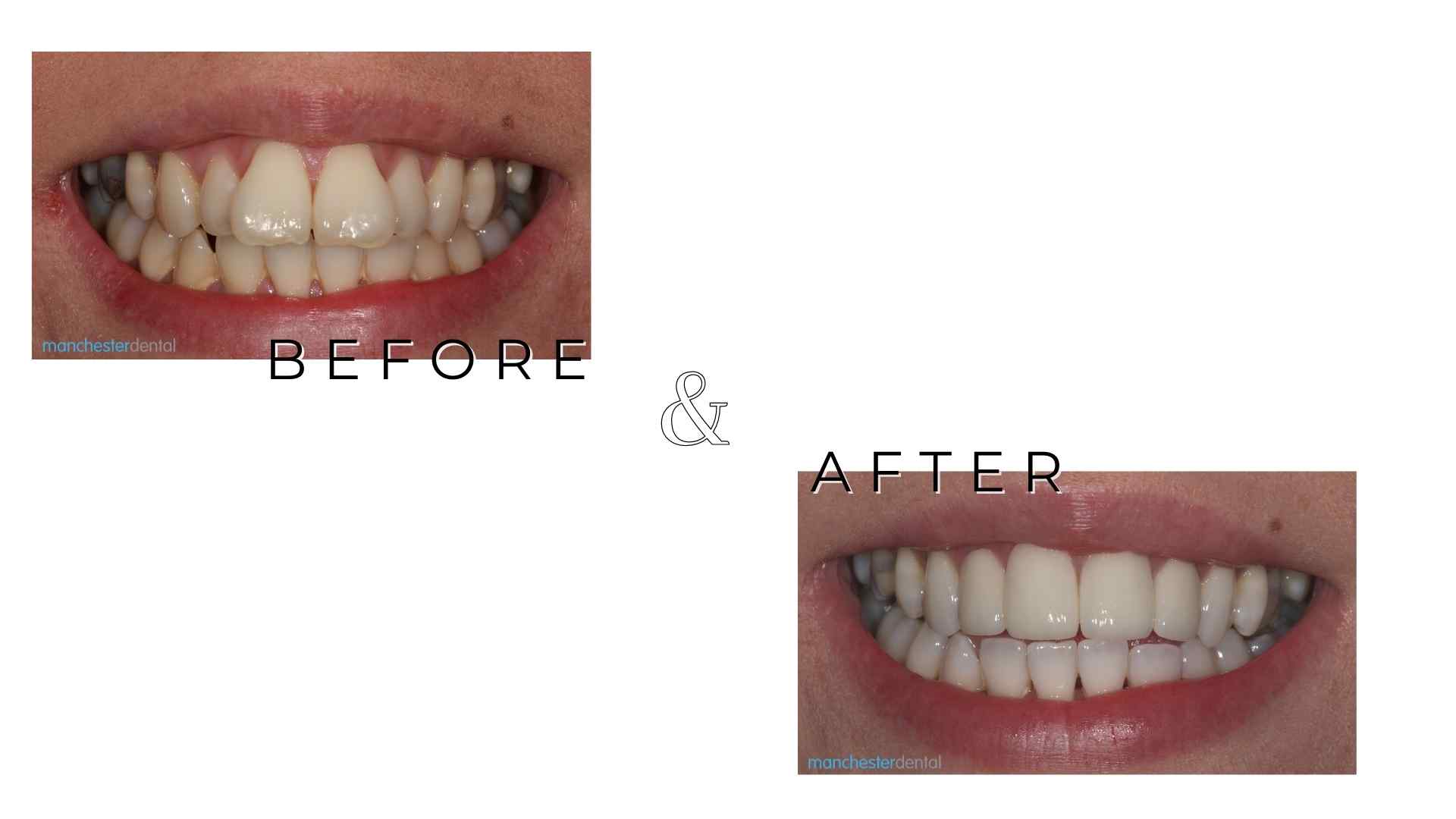 composite bonding in manchester Manchester Dental