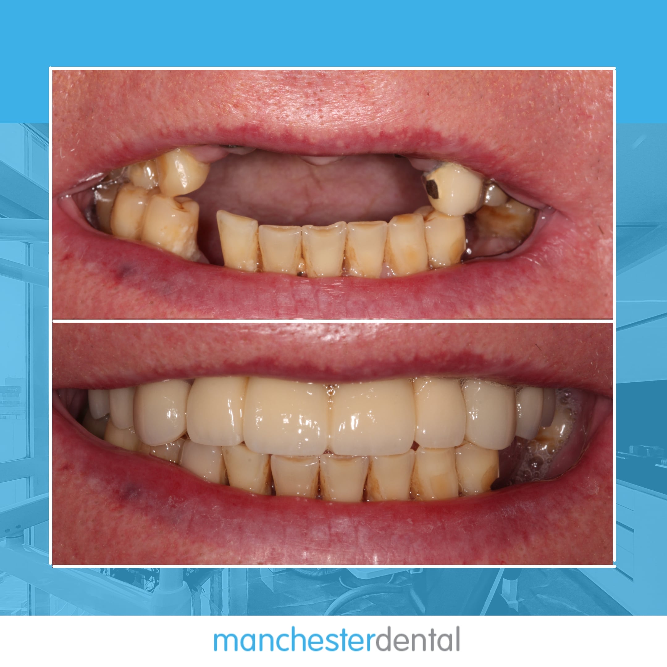 about dental implants