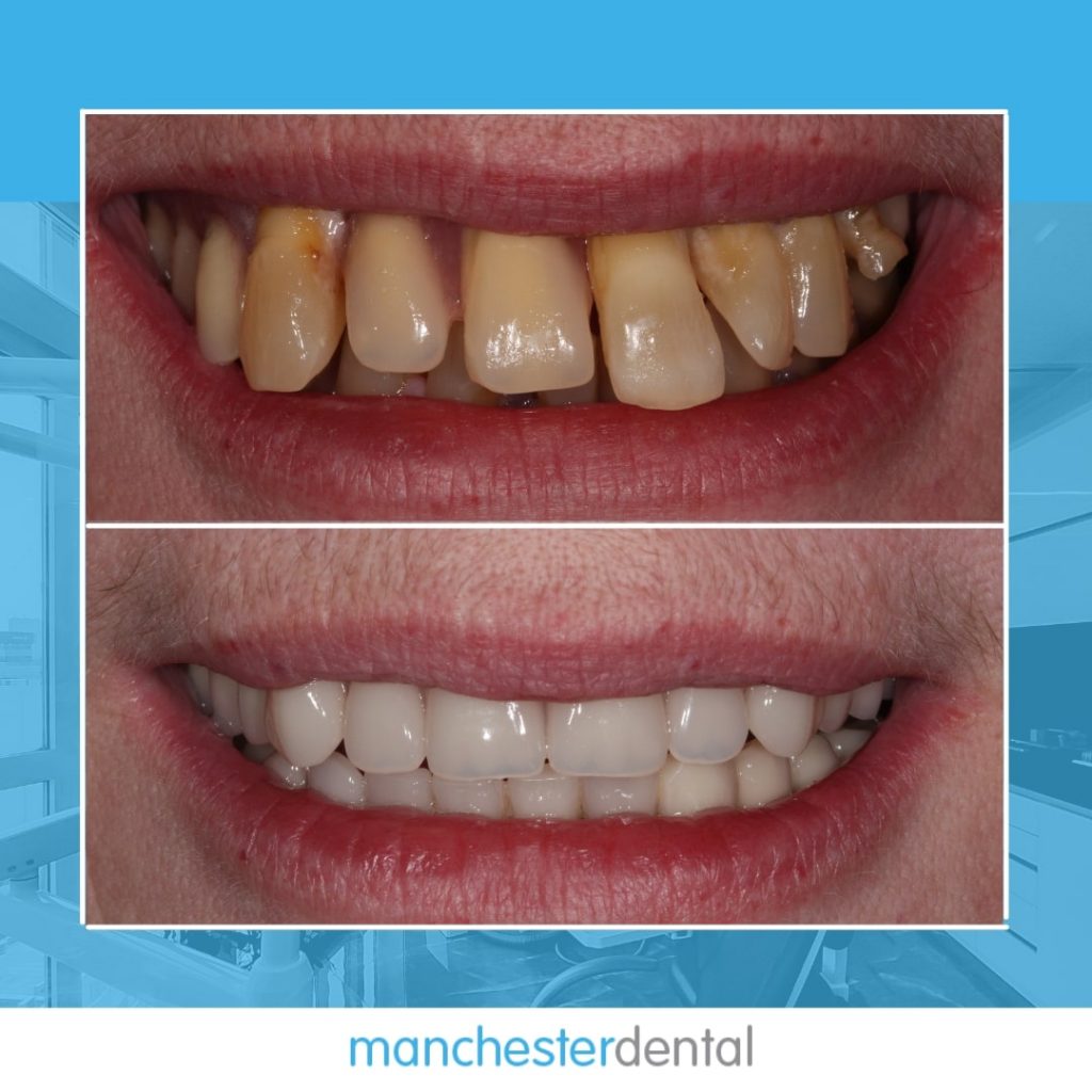 about dental implants