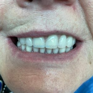 dental implants in manchester uk