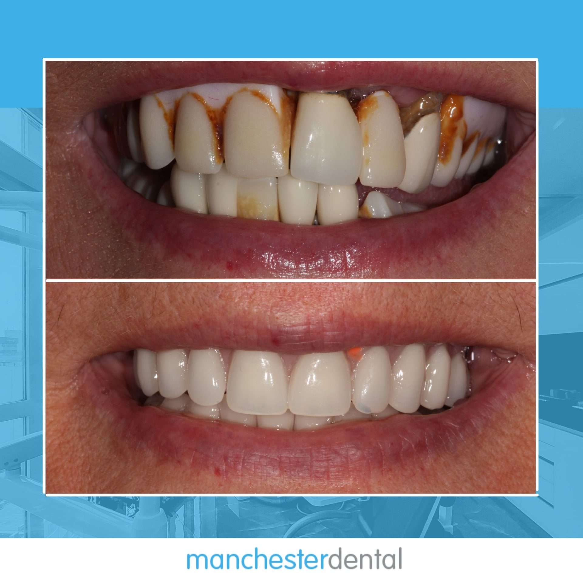 about dental implants
