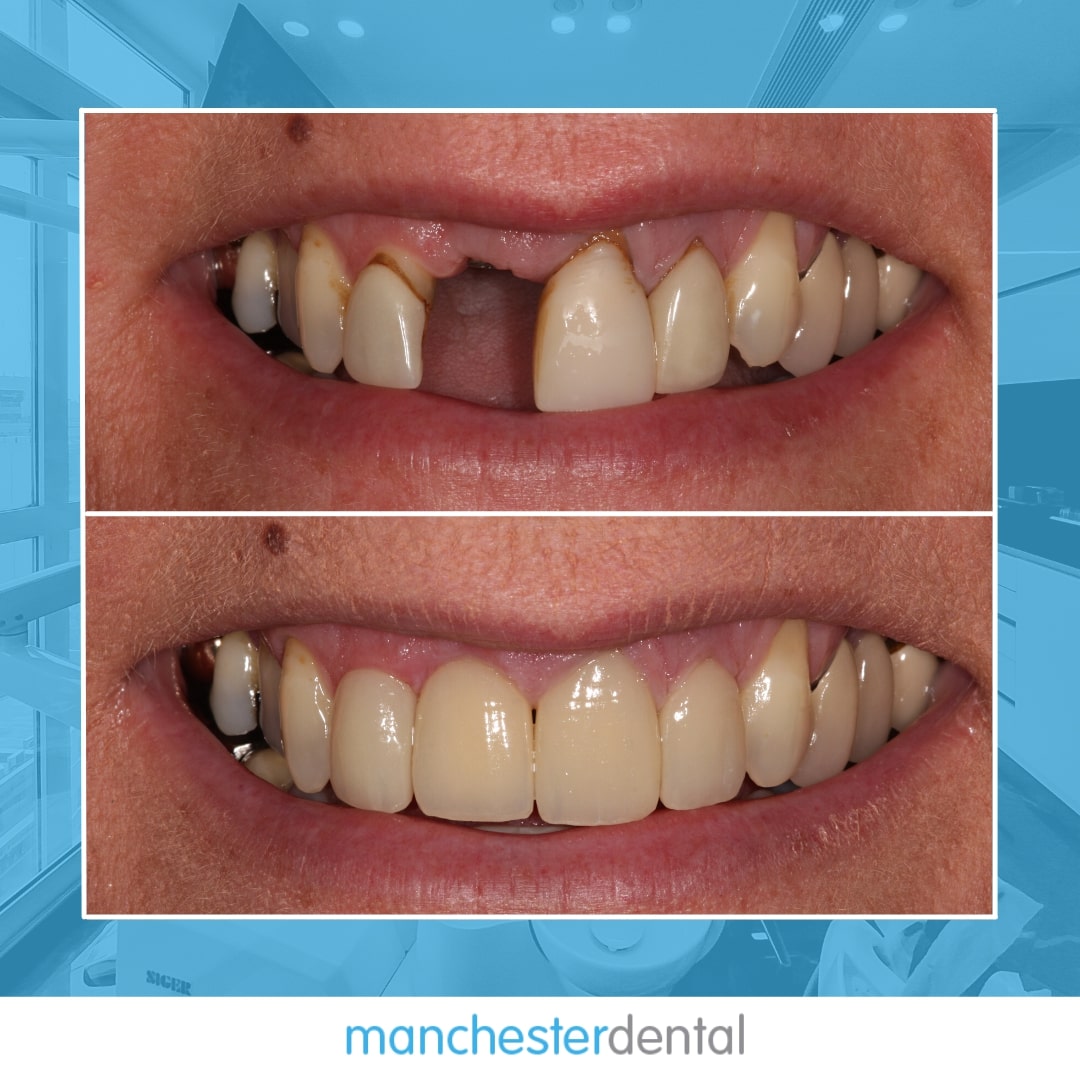 about dental implants