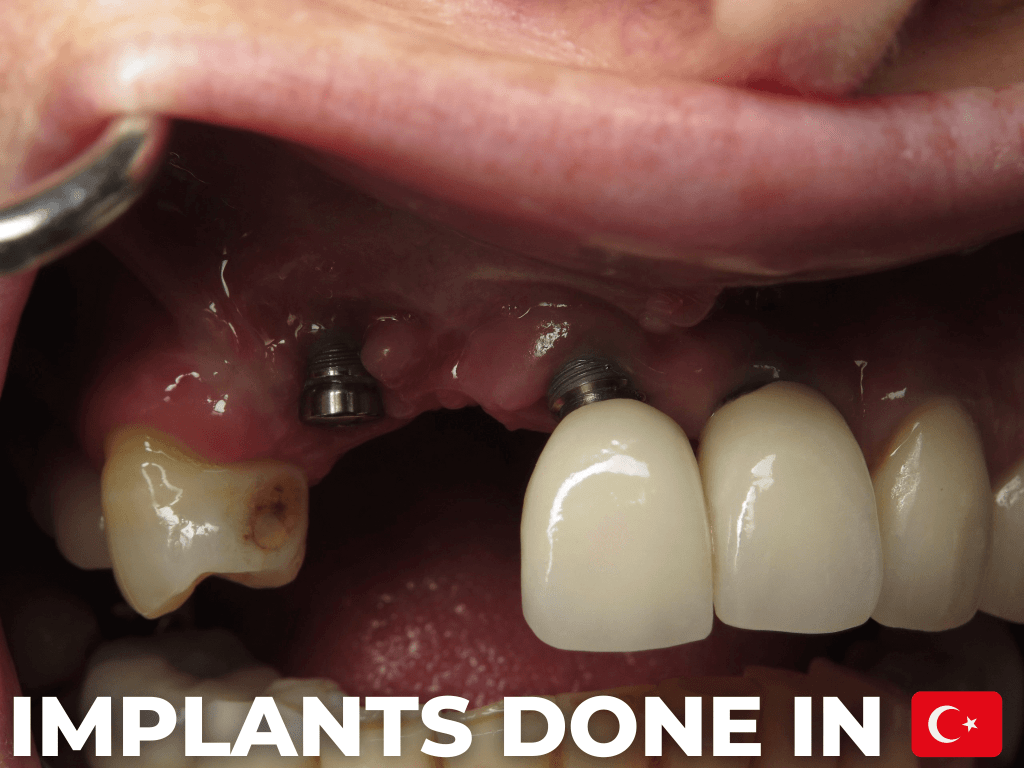 Turkish dental implants