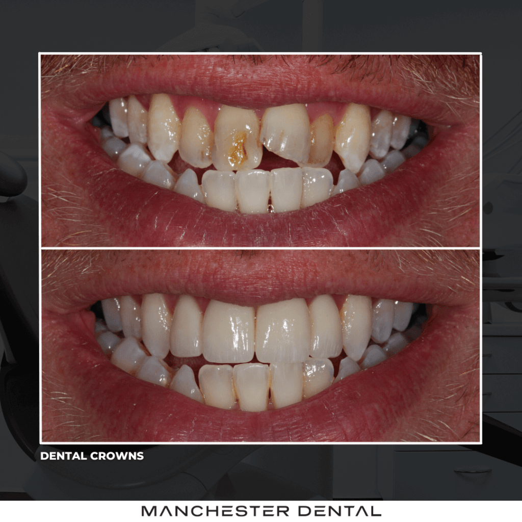 dental crowns manchester