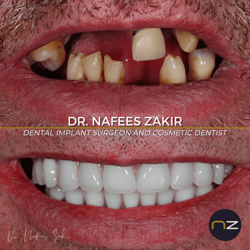 what teeth implants