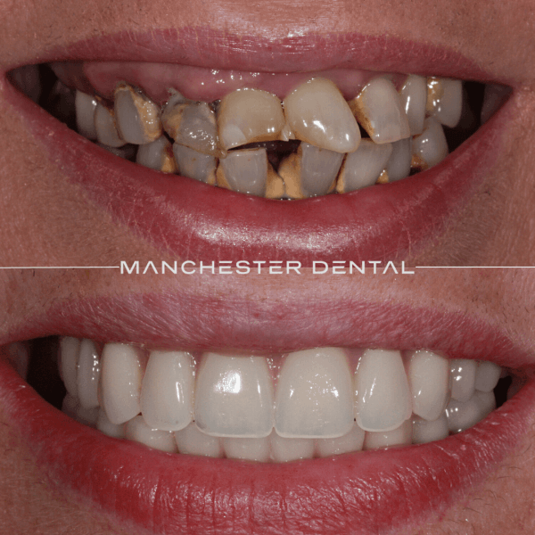 all on 4 dental implants manchester