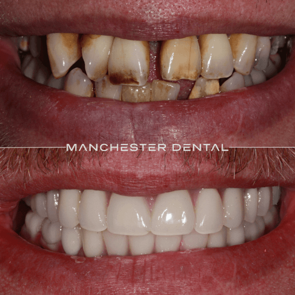 dental implant bridge manchester