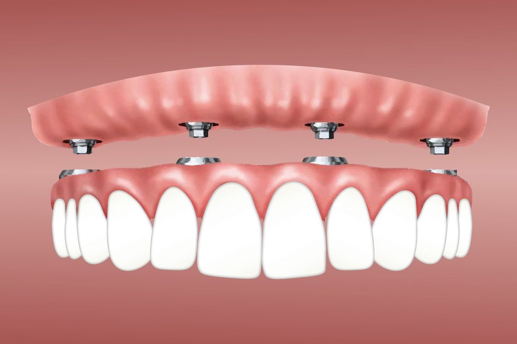 Dental implants manchester