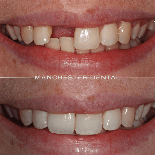 dental implants manchester