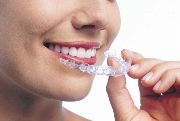 invisalign transformation