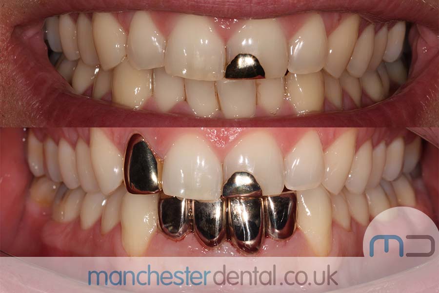 Gold Teeth / Gold Crowns Manchester Dental