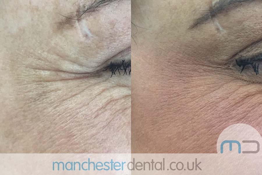 anti wrinkle treatment in manchester