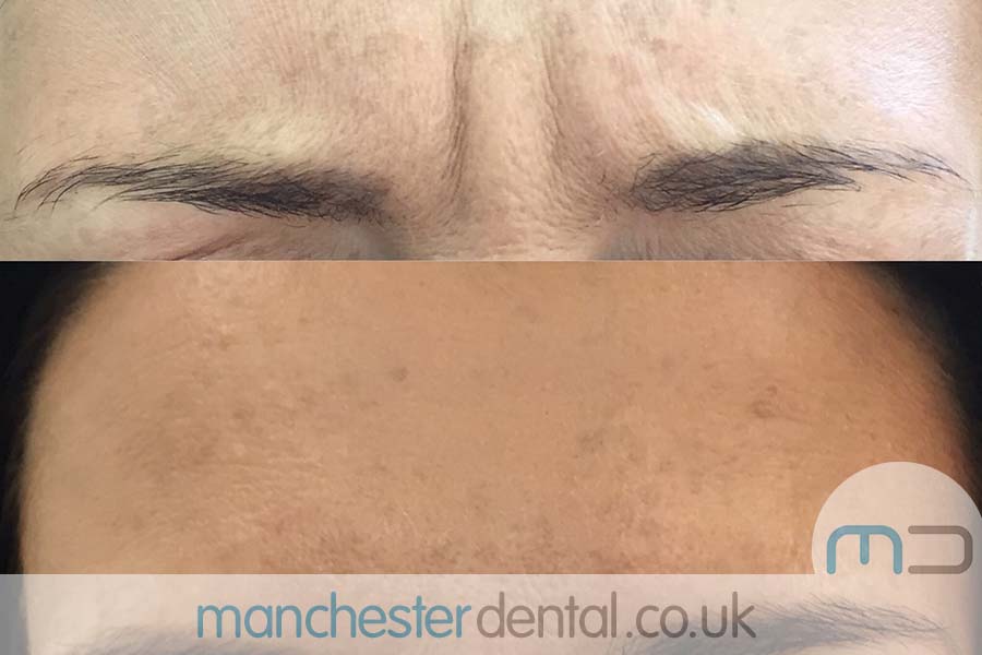 anti wrinkle treatment in manchester