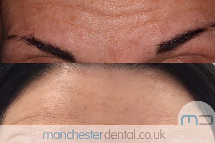 anti wrinkle treatment in manchester