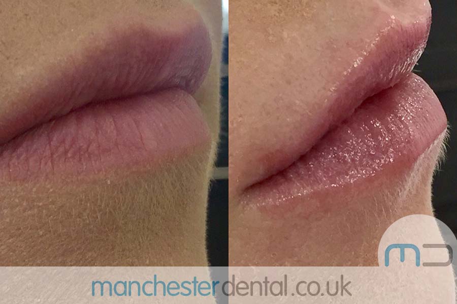 anti wrinkle treatment in manchester