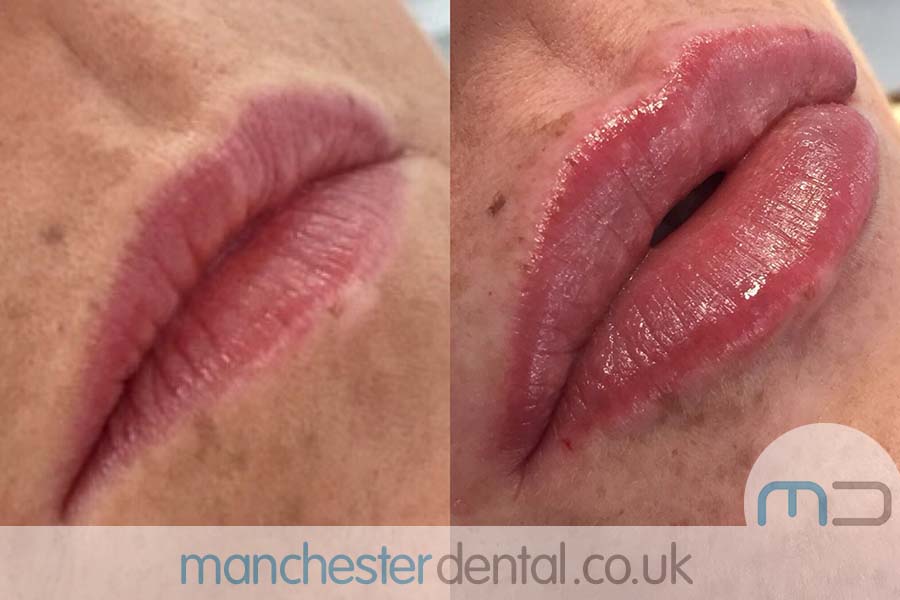 anti wrinkle treatment in manchester