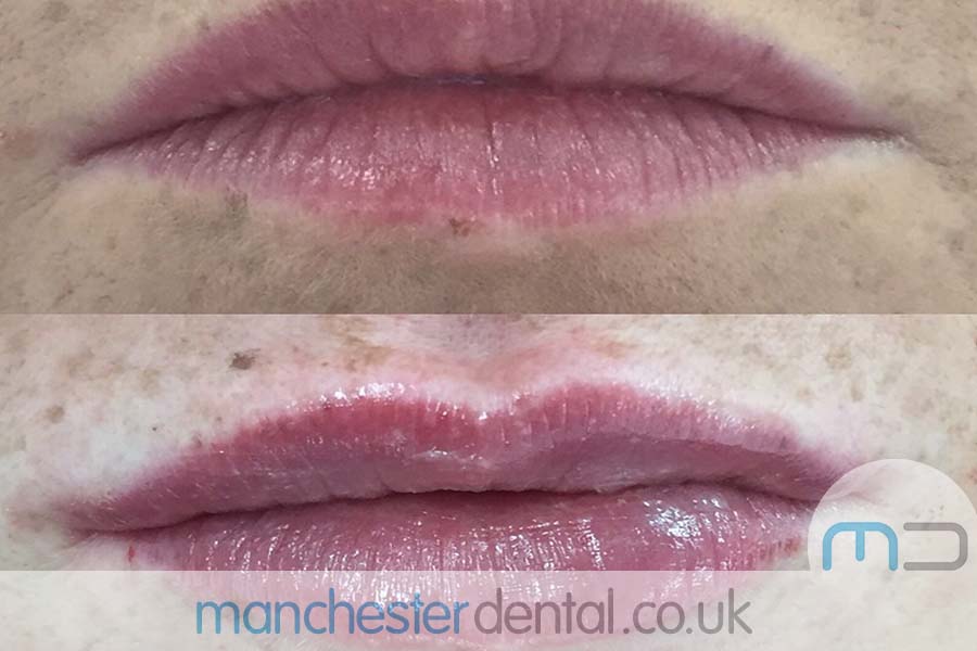 anti wrinkle treatment in manchester