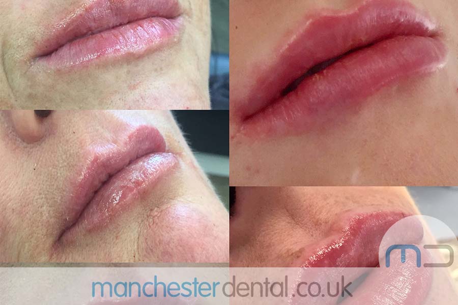 anti wrinkle treatment in manchester