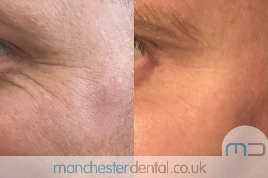 anti wrinkle treatment in manchester