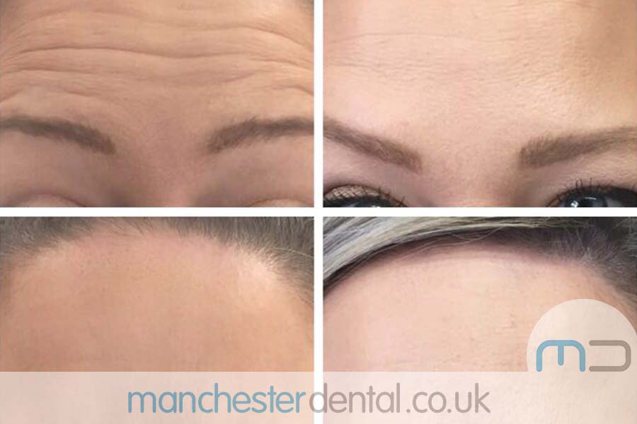 anti wrinkle treatment in manchester