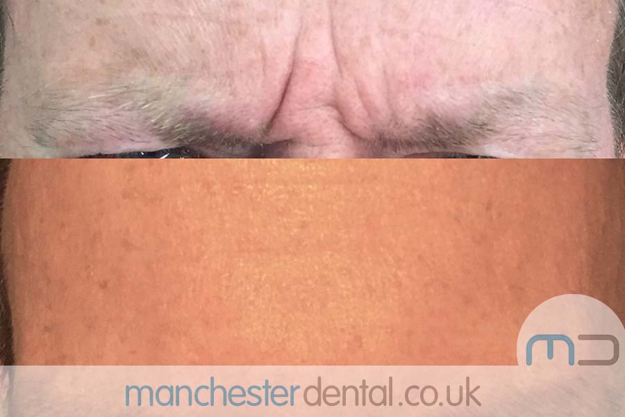 anti wrinkle treatment in manchester