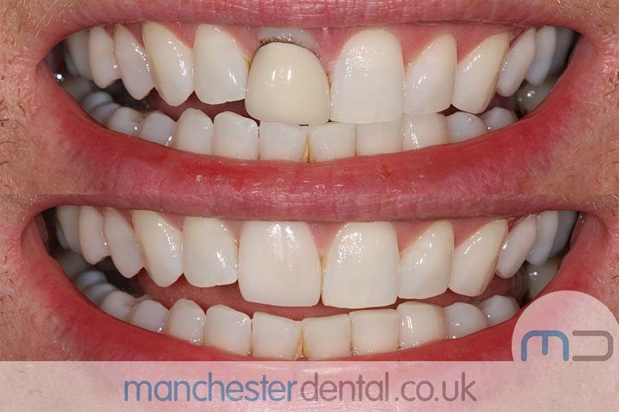 crowns and veneers in manchester