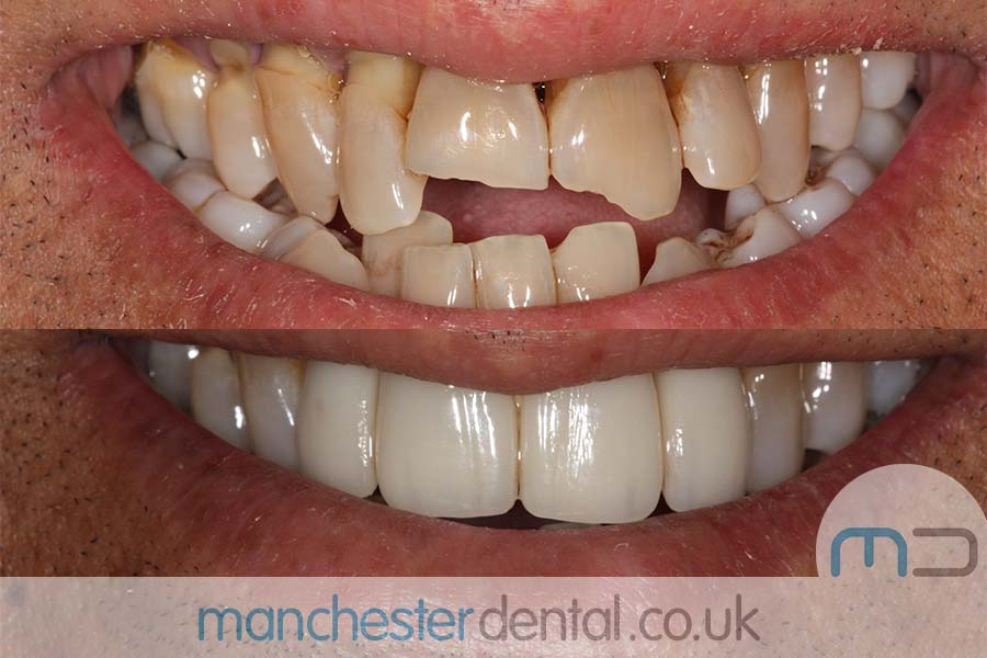 crowns and veneers in manchester