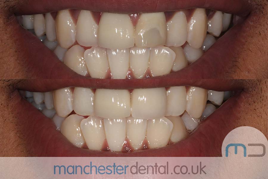 crowns and veneers in manchester