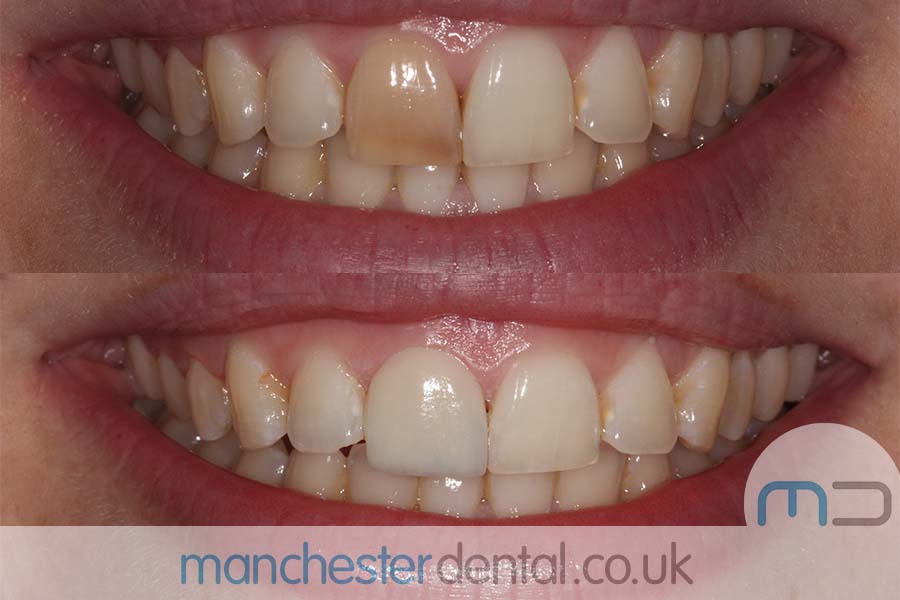 crowns and veneers in manchester