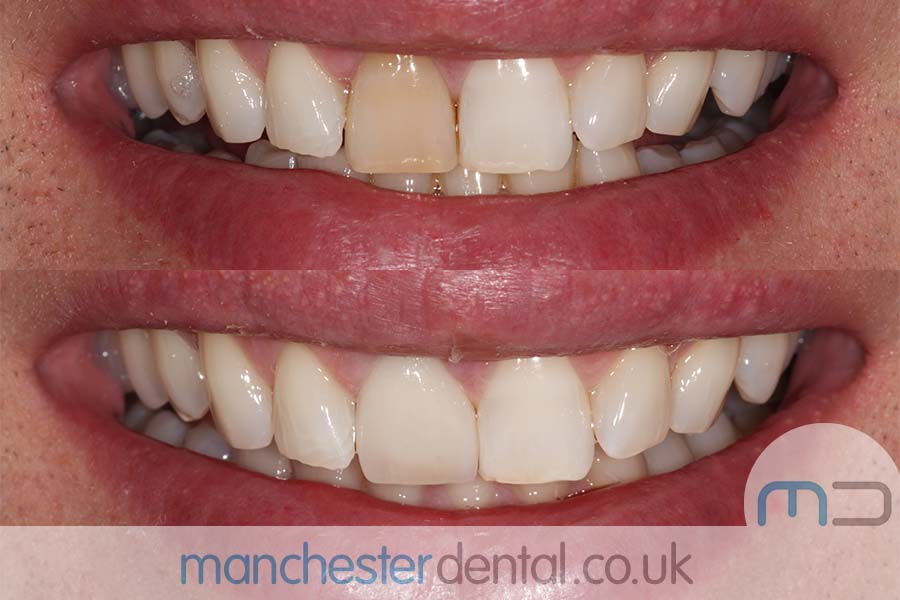 crowns and veneers in manchester