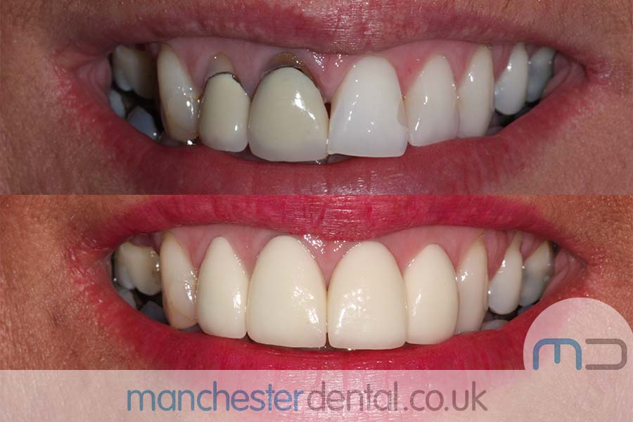 crowns and veneers in manchester