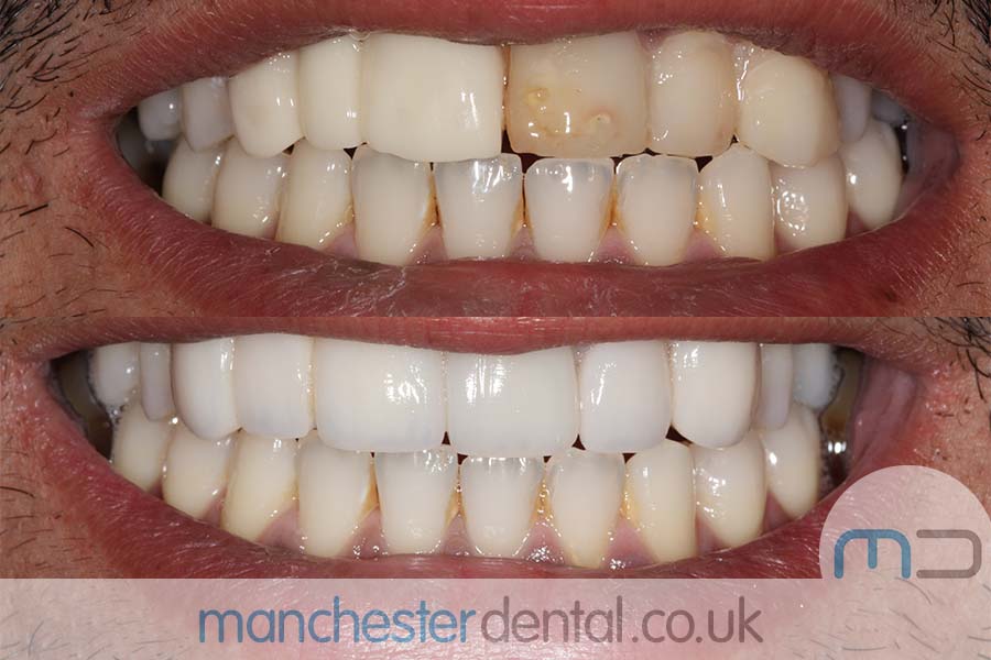 crowns and veneers in manchester