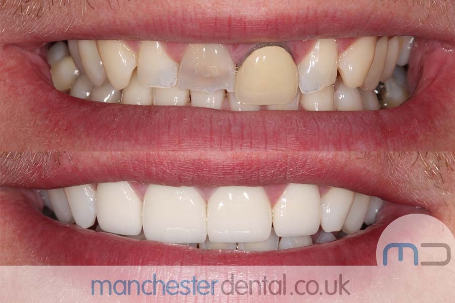 crowns and veneers in manchester