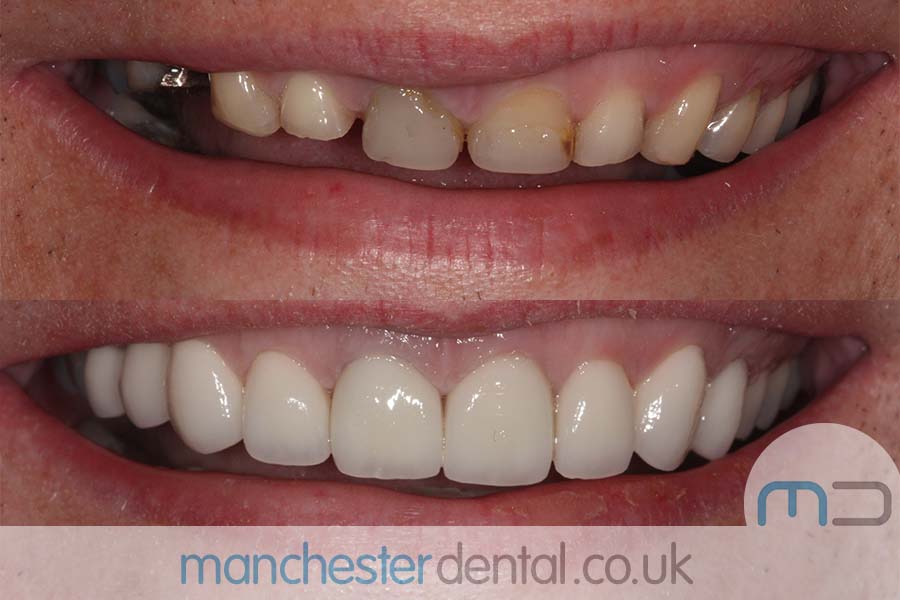 crowns and veneers in manchester