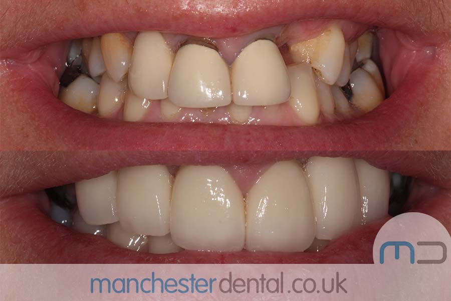 crowns and veneers in manchester