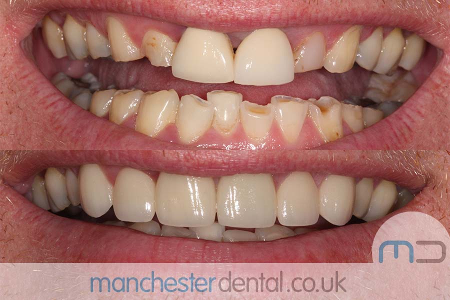 crowns and veneers in manchester