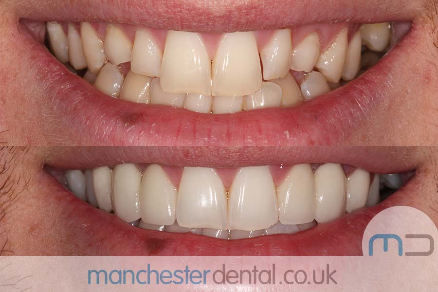 crowns and veneers in manchester